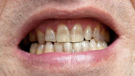 Having Tetracycline-Stained Teeth? Learn about Effective Teeth Whitening Solutions