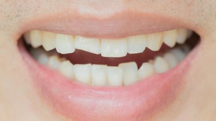 Cracked Tooth Repair: Understanding the Options for Restoring Dental Health